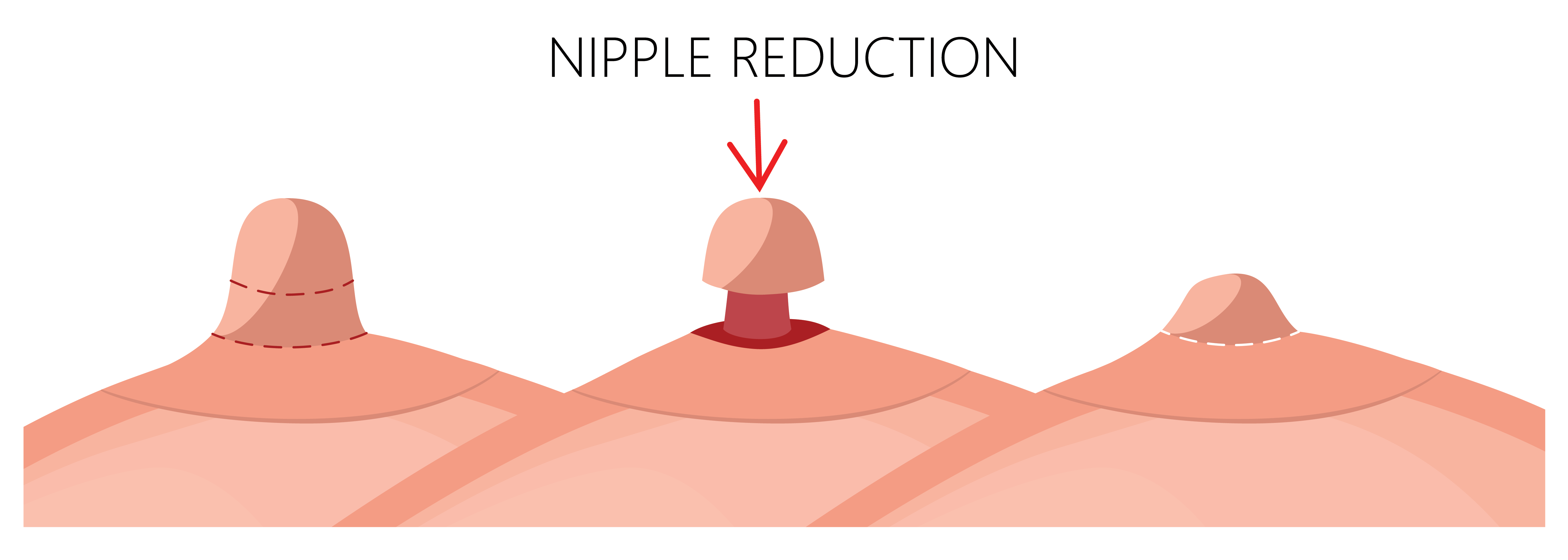 Plastic-Surger–)-Breast–)-Nipple-Reduction