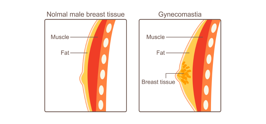 Plastic Surgery -_ Men Procedures -_ Gynecomastia 3